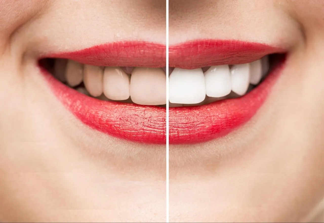 Teeth-Whitening-Cosmetic-Dentistry