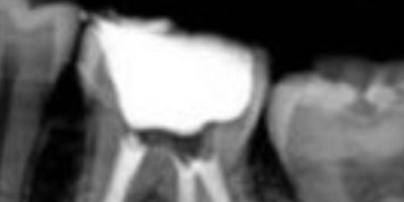 root canal treatment tooth