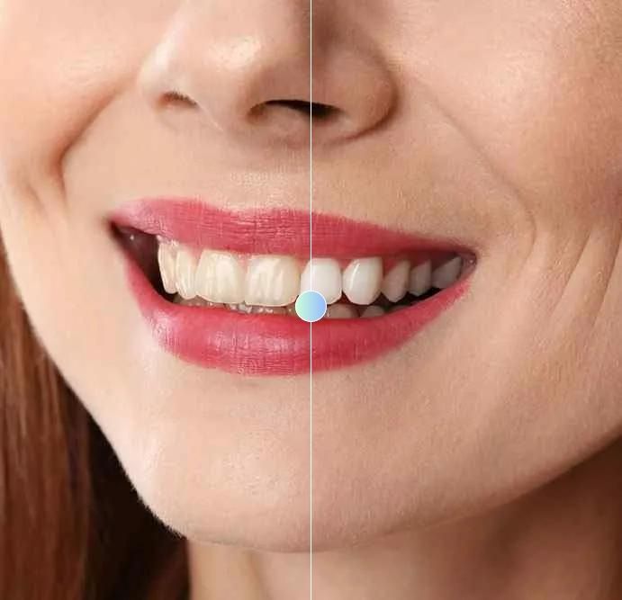 teeth-before-&-after